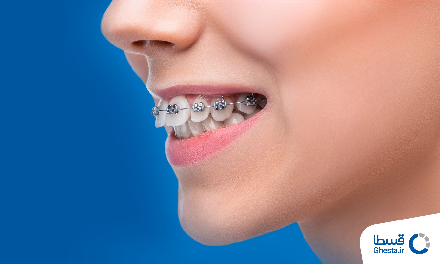 زیبایی دندان - ارتودنسی